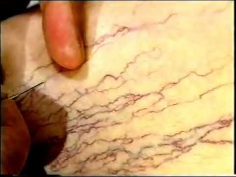 Video: Kuņģa Fistula - Kuņģa Fistulas Cēloņi, Simptomi, Komplikācijas Un ārstēšana