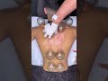 Fire Cupping Therapy 🔥 | Natural Solution for Body Pain &amp; Muscle Recovery
