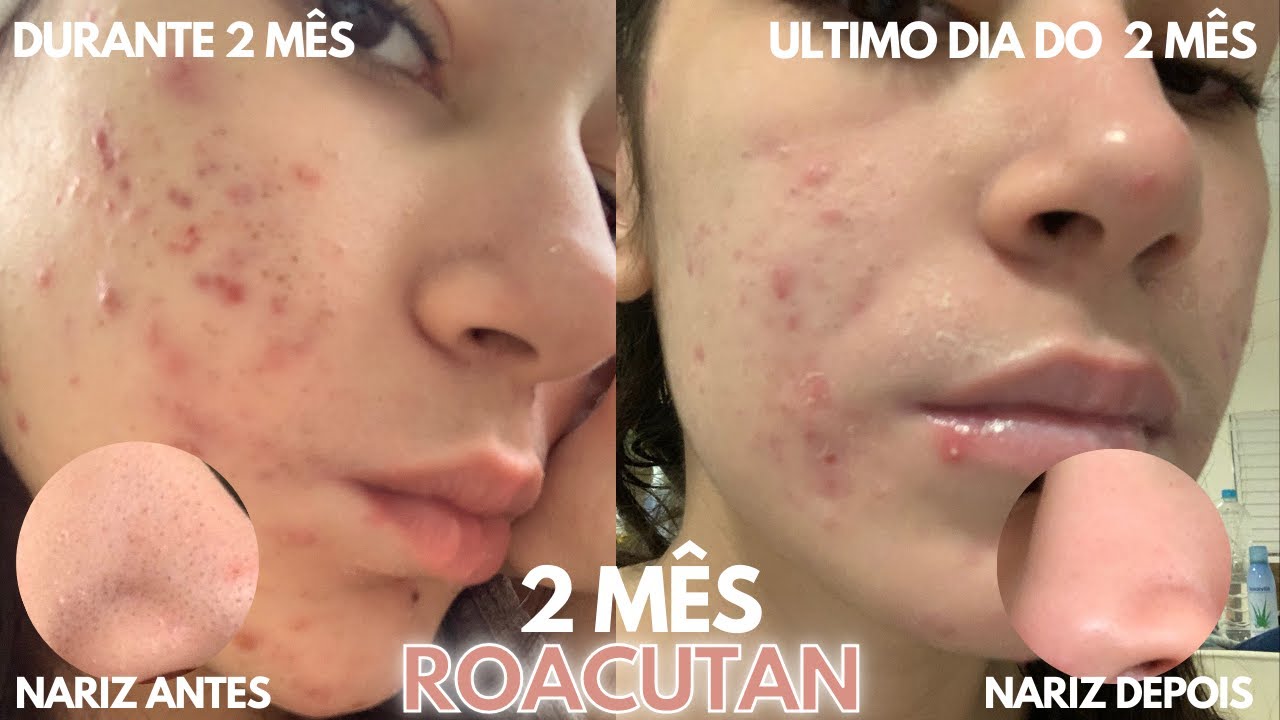 2º MÊS ROACUTAN | Diário Roacutan - YouTube