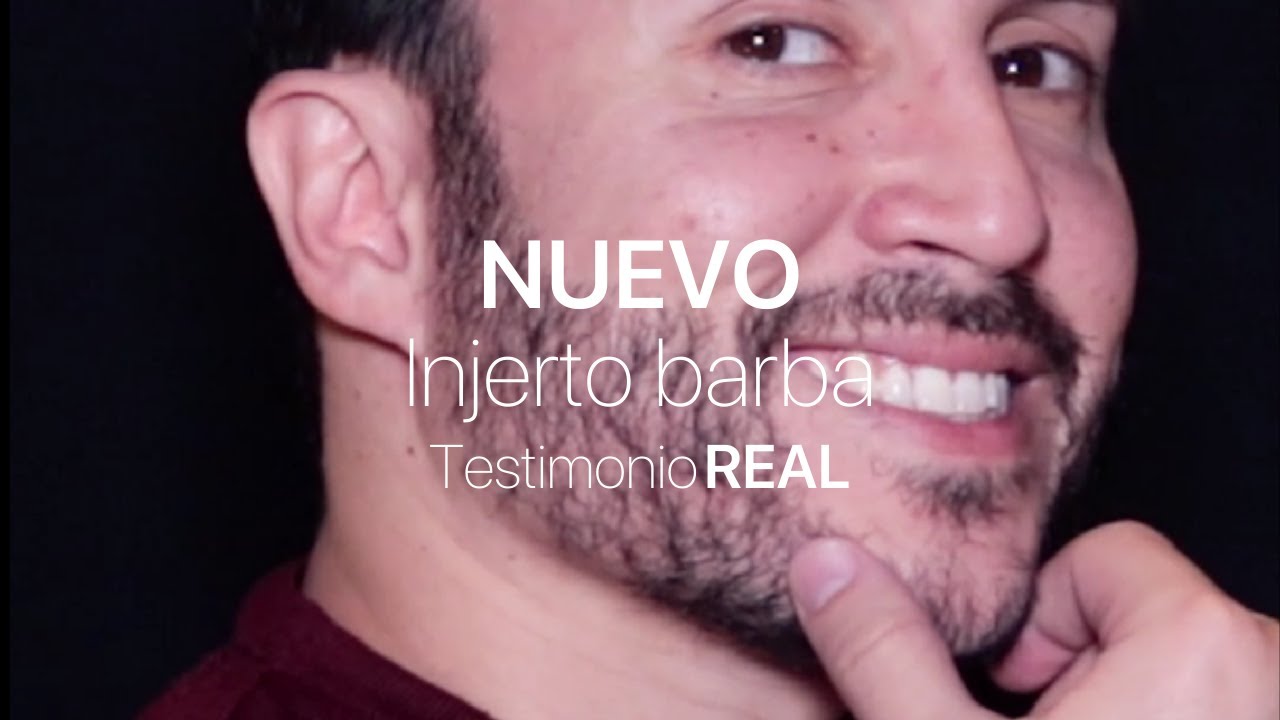 Injerto de barba - Testimonio REAL