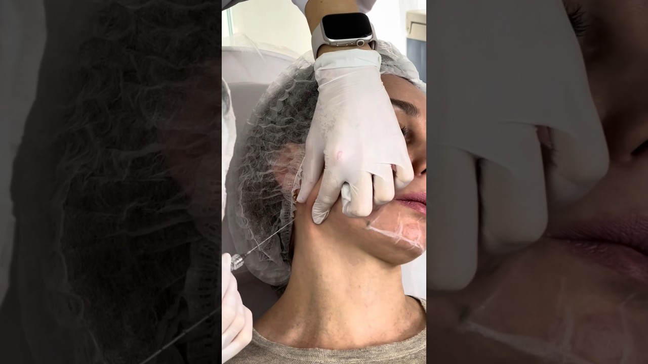 Radiesse - моделируем лицо. #радиес #radiesse #омоложение #подтяжкалица #брыли #скулы #дряблостькожи