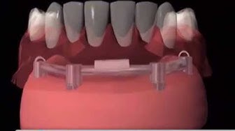 Oxnard Dentist - Affordable Dental Implants - Andres Dental in Oxnard CA