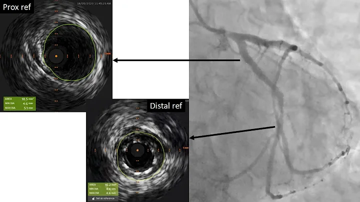 IVUS guided PCI with MagicTouch SCB successfully undertaken in a 59-year old man