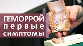 Признаки геморроя. 😨 Первые признаки геморроя и трещины заднего прохода. МОСИТАЛМЕД