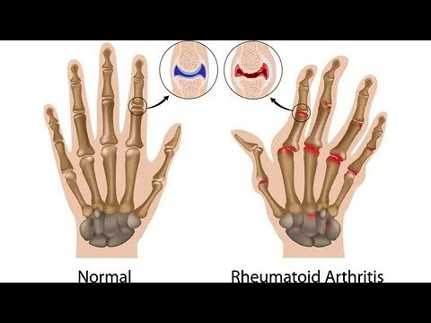 Хруст пальцами  Вредно ли хрустеть пальцами