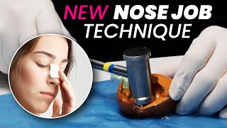 New Rhinoplasty Technique! Faster Recovery, Less Bruising