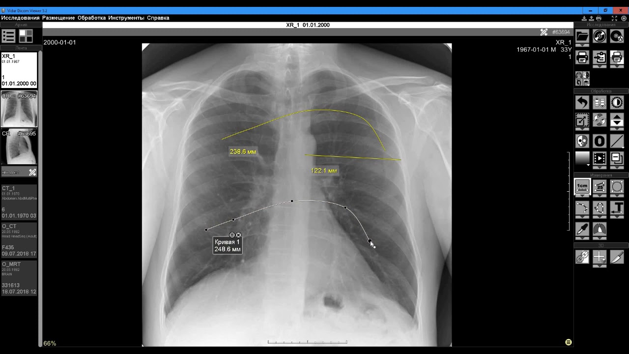 Измерения в Vidar Dicom Viewer.  Фильм первый