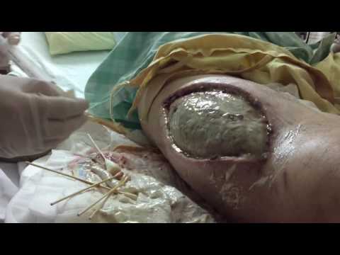 筋膜炎維基 壞死性筋膜炎 維基百科 自 1 健康跟著走