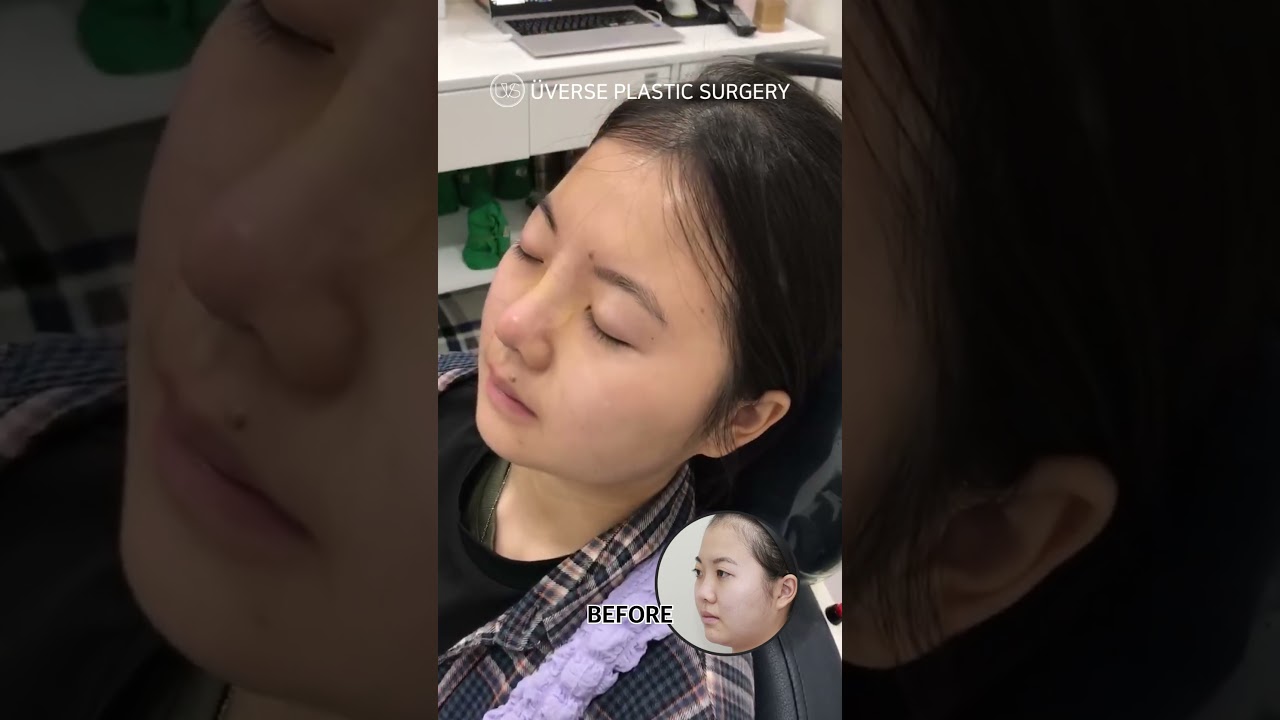 [Веберс гоо сайхны мэс заслын эмнэлэг] Хамрын мэс засал туухай авах 💚 7 дахь өдөр