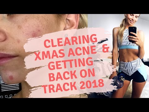 GETTING RID OF ACNE & GETTING DIET BACK ON TRACK FOR 