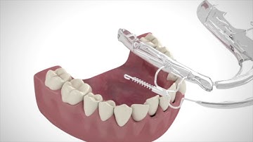 Inman Aligner   How it works?