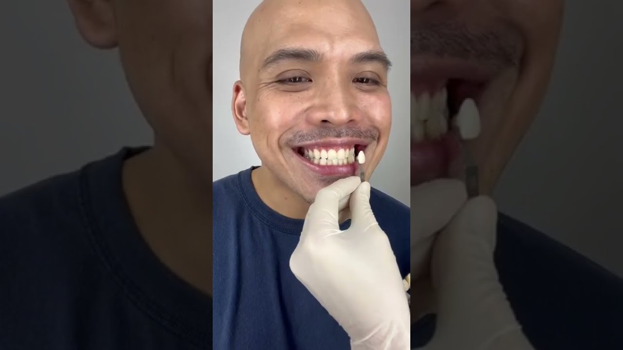 @TheBaldBakerPH tries out The Smile Bar's Teeth Whitening!