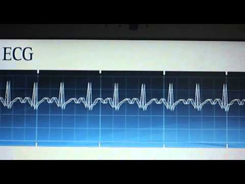 Sinus Tachycardia - YouTube