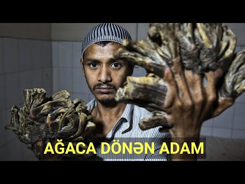 AĞAC ADAM! BU İNSAN GETDİKCƏ AĞACA DÖNÜR!