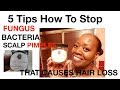 5 Tips How To Stop Fugus,Bacteria and Scalp Pimples, That causes hair LOSS!