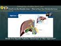 Divide the hepatic pedicles glissonean or hilar approach