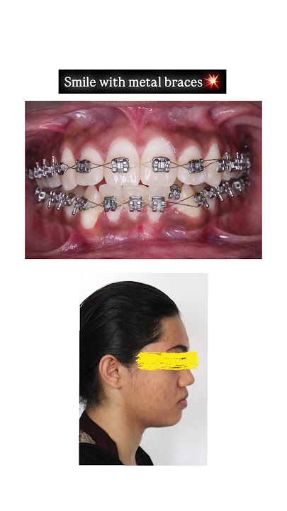 😍Wow braces and beautiful smiles #dental #braces #bracesoff #hyderabaddentist #smile #orthodontist