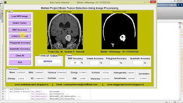 Matlab Project Brain Tumor Detection Using Image Processing Full Source Code || IEEE Based Project