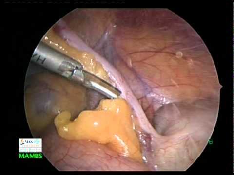 PPH Procedure Animation | Stapled Hemorrhoid Surgery