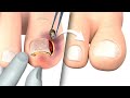 Ingrown toenail removal treatment  step by step