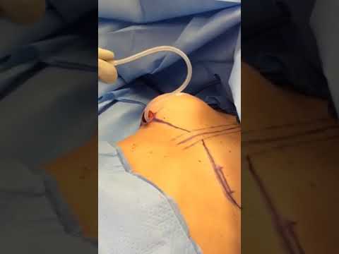 Filling an Implant Sizer #shorts