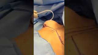 Filling an Implant Sizer #shorts