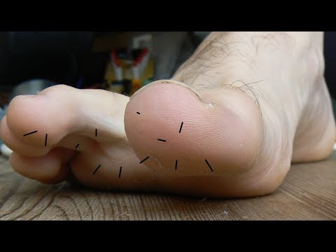 Vidéo: Comment enlever les épines d'oursin de vos pieds