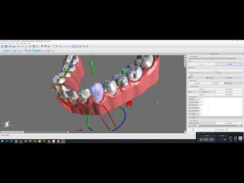 In-house Aligners using Blue Sky Bio Desktop Scanner and Blue Sky Plan