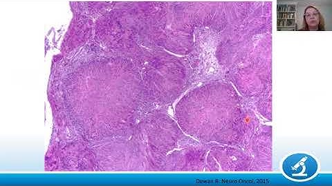 AANP Teaching Rounds - October 26 - Peripheral Nerve Sheath Tumors in Neurofibromatosis