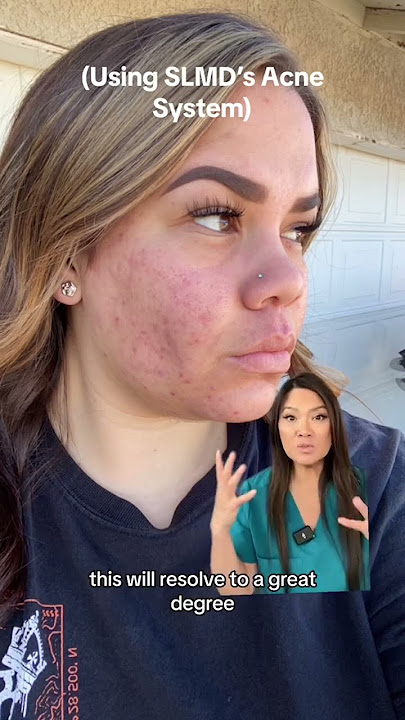 I love seeing real results from real people using my SLMD Acne System! ❤️