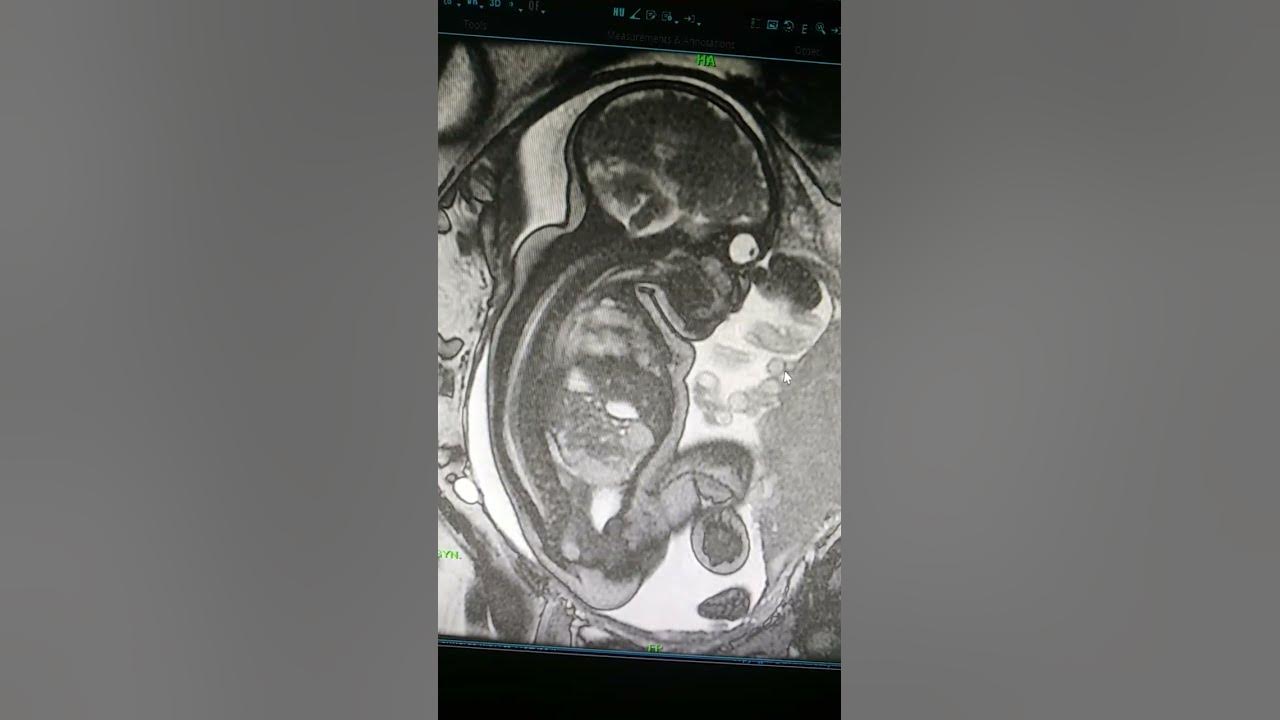 mri-in-pregnancy-baby-in-mri-scan-radiology-youtube
