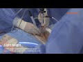 Endovision spine spine scope kit with ube endoscopic surgery