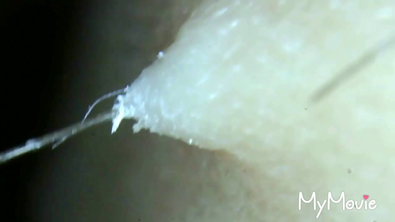 Best Compilation Of Ingrown Hair Plucking Scabs And Gross Hairs
