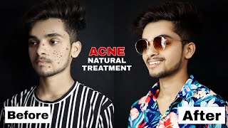 How to reduce acne | Overnight | Pimples removal cream | Natural | Fast acne treatment | Hindi 2020