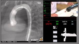 Endovascular Repair of Ruptured Thoracic Aneurysm