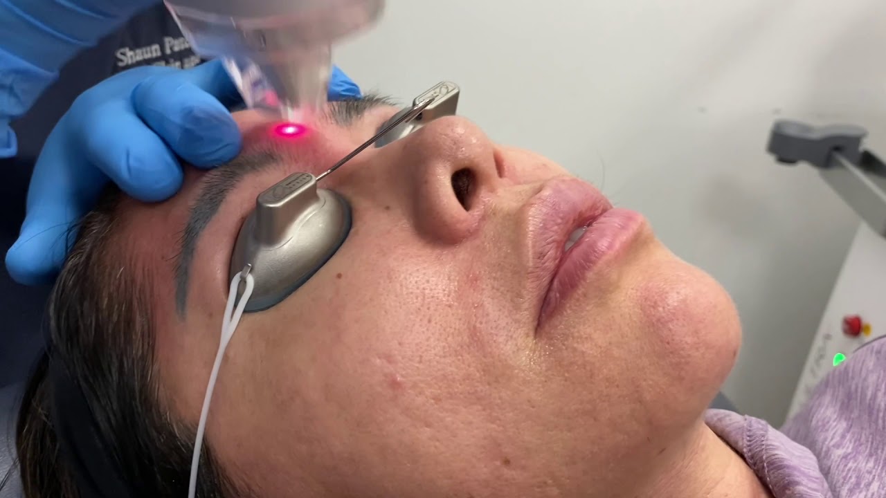 LaseMD Ultra laser treatment for hyperpigmentation and skin rejuvenation in Miami, FL by Dr. Patel