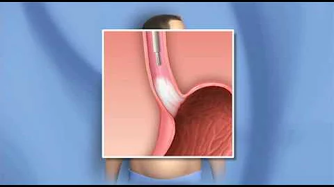 Medical Treatment for Barretts Esophagus, Radiofrequency Ablation, Cryotherapy-Mayo Clinic
