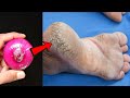 Remove Cracked Heels And Get Beautiful Feet Permanently Magical Cracked Heels Home Remedy 