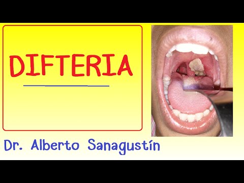 Vídeo: Difteria: Causas, Síntomas, Métodos De Tratamiento, Prevención