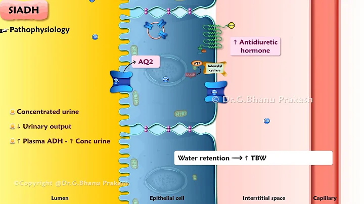 Syndrome of Inappropriate Antidiuretic Hormone Secretion ( SIADH ) : Nephrology : Internal Medicine