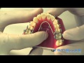 Quad helix en ortodoncia: en qué consiste | Ortodoncia Zamalloa