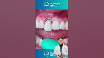 Thay Đổi Nụ Cười Với Implant Răng Cửa  |Dr Cường Official