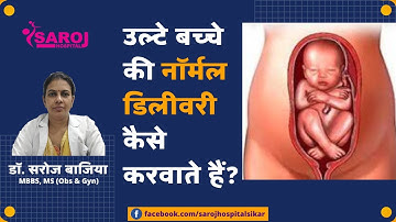 उल्टे बच्चे की नॉर्मल डिलीवरी कैसे करवाते हैं? Normal Delivery In Breech Presentation...Dr. Saroj