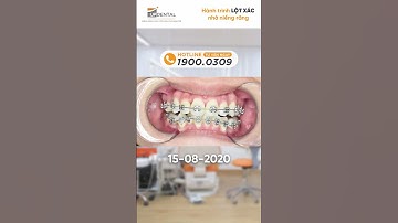 Hành trình LỘT XÁC nhờ niềng răng của Võ Thị Nhị