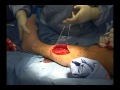 Four Compartment Fasciotomy of the Leg