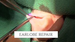 Ear Piercing Gauges | Earlobe Repair | Earlobe Reduction Surgery in Beverly Hills