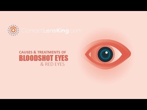 Video: Eye Redness - Causes, Symptoms, Eye Drops From Eye Redness