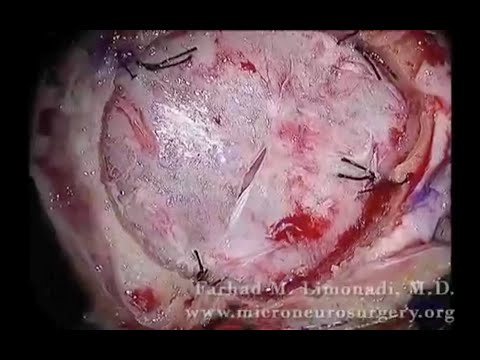 Brain surgery removal of metastatic tumor high power surgical microscope