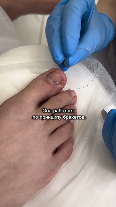 Коррекционные системы применяются при вросшем ногте и деформации ногтей ...