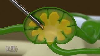 Lymphangiography And Intranodal Glue Embolization For Treatment Of Lymphocele